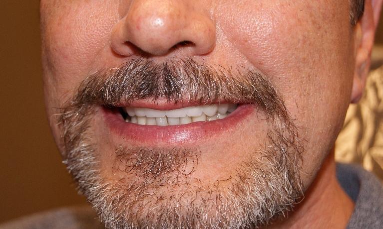 Complete-Smile-Restoration-After-Image
