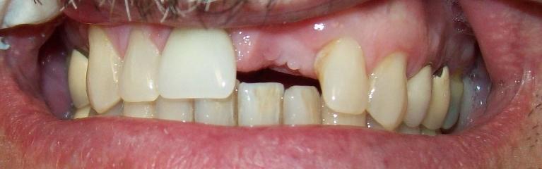 Complete-Smile-Restoration-Before-Image