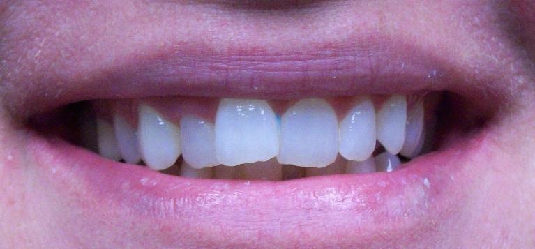 Six-Month-Smiles-Before-Image