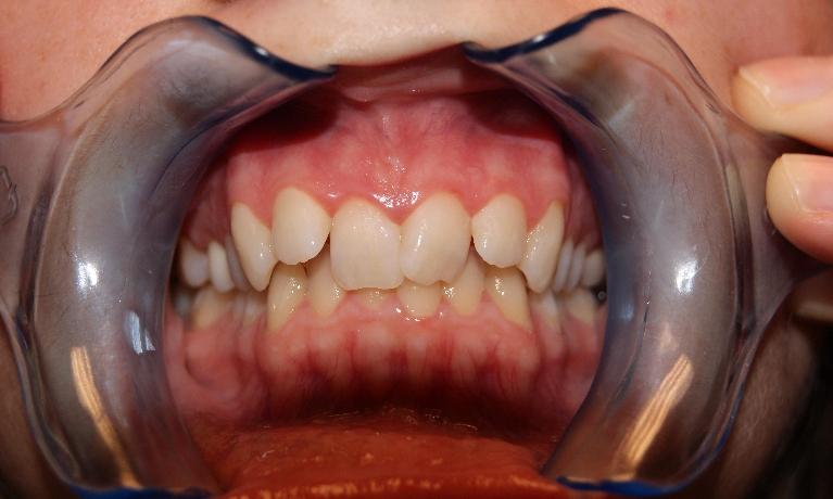 Six-Month-Smiles-Before-Image